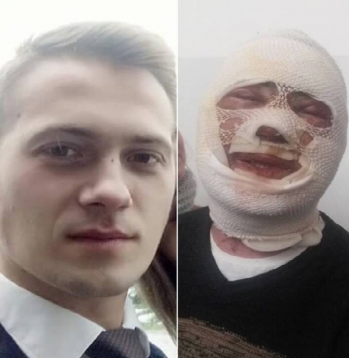 Одеські медики рятують зір ужгородцю, якому в обличчя плеснули кислотою