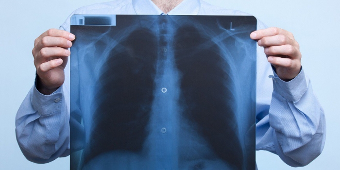 Ситуація з туберкульозом на Закарпатті все ще напружена