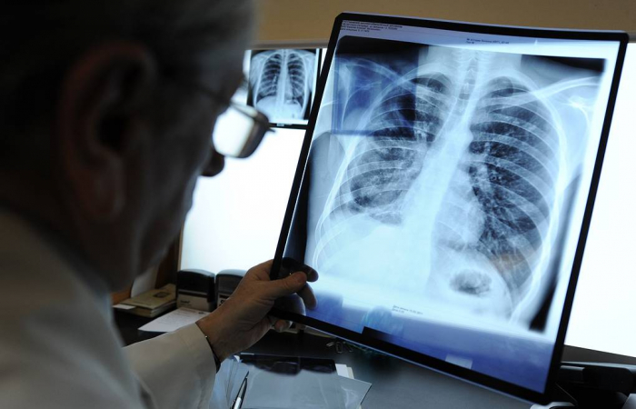 На Закарпатті хворі з закритою формою туберкульозу лікуватимуться у сімейних лікарів