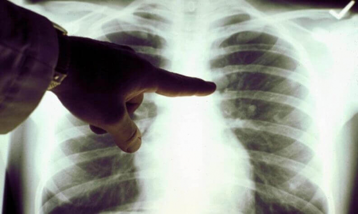 Два мобільні цифрові рентгенодіагностичні кабінети отримали закарпатські фтизіатри