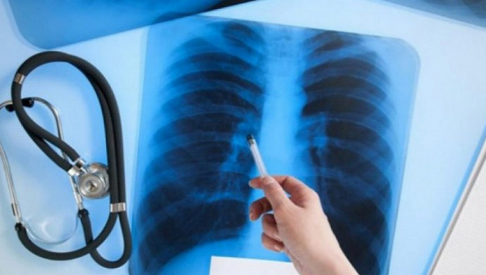 315 випадків туберкульозу за І квартал: закарпатцям нагадали про страшну недугу