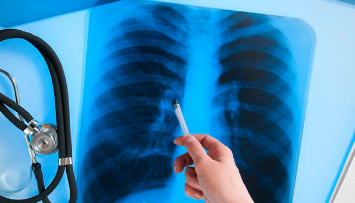 Керівник закарпатського «Центру легеневих хвороб» розповів про ситуацію з туберкульозом в області