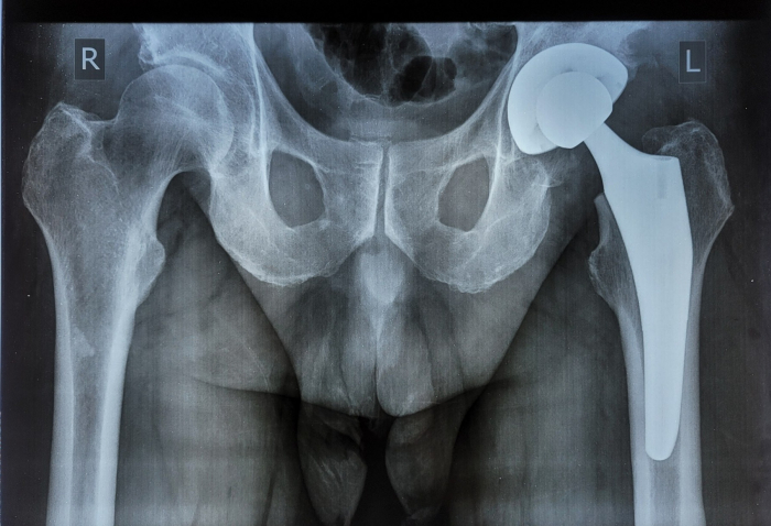 У Закарпатській обласній лікарні проводять безкоштовне ендопротезування кульшових суглобів