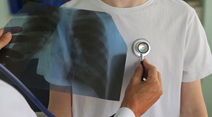 Кашель, що не минає: медики Закарпаття закликають перевірятись на туберкульоз