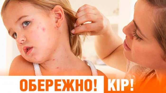 На Закарпатті знову фіксують випадки кору